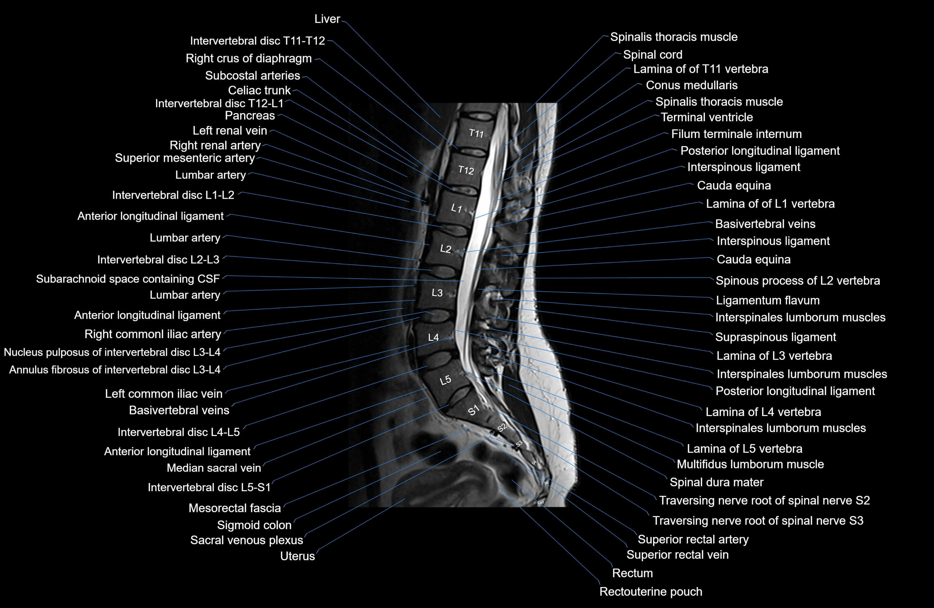 MRI lumbar spine sagittal cross sectional anatomy 3T radiology  image-img-00001-00014.webp